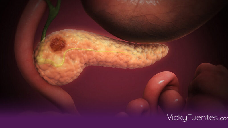 Cáncer de páncreas, la sombra del 2030: Será la segunda causa de muerte oncológica global por el diagnóstico tardío