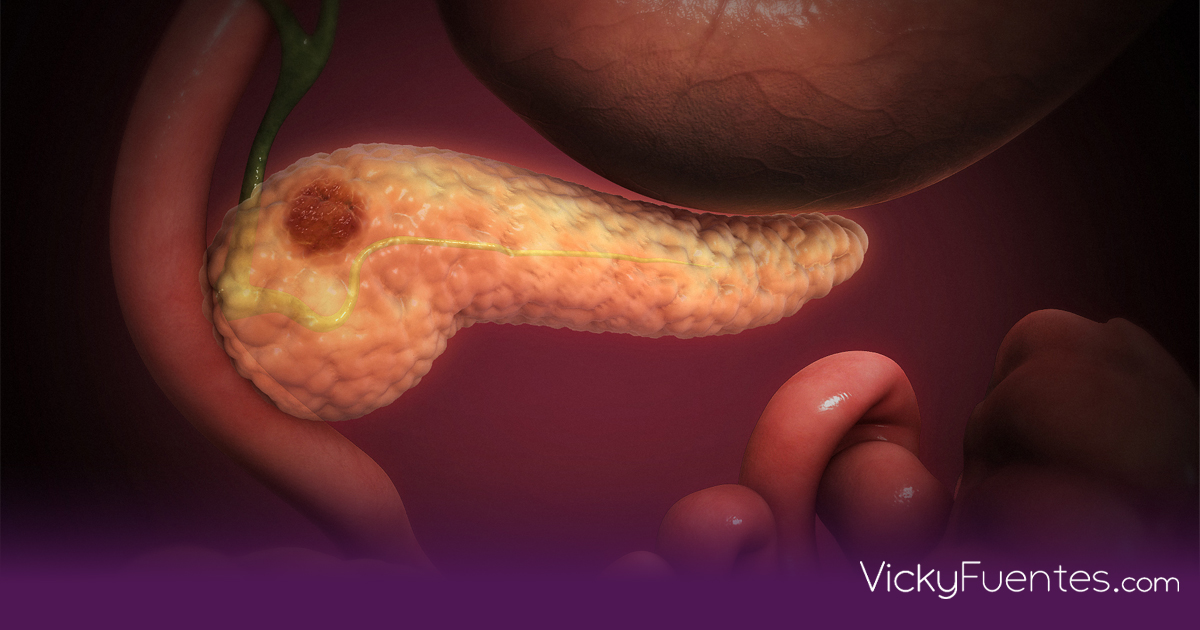 Cáncer de páncreas, la sombra del 2030: Será la segunda causa de muerte oncológica global por el diagnóstico tardío