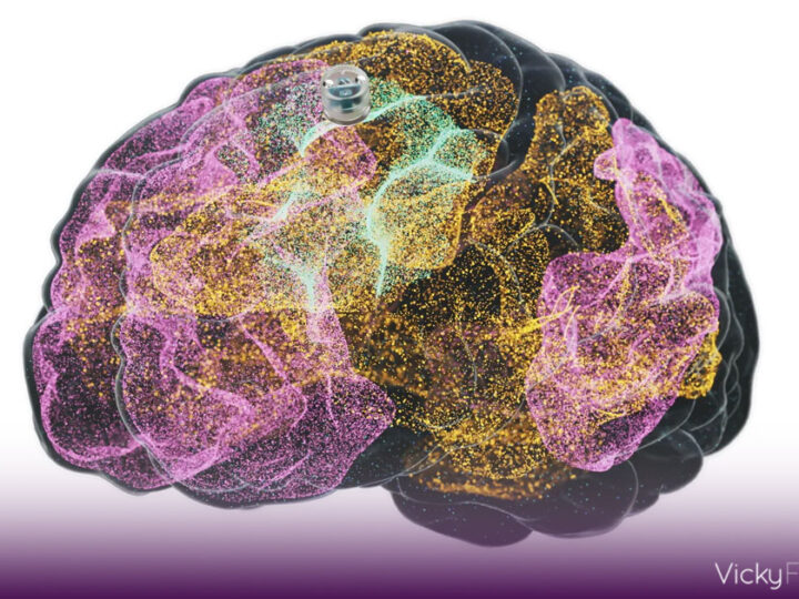Aprueban primer implante cerebral para tratar depresión en humanos